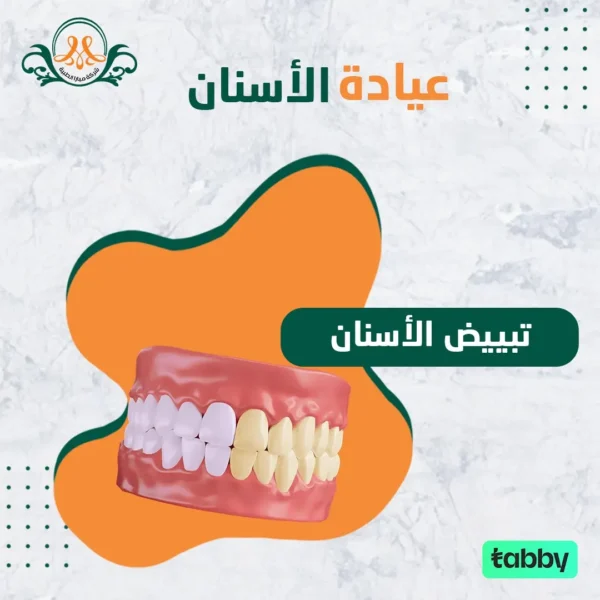 تبييض الأسنان