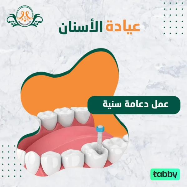عمل دعامة سنية