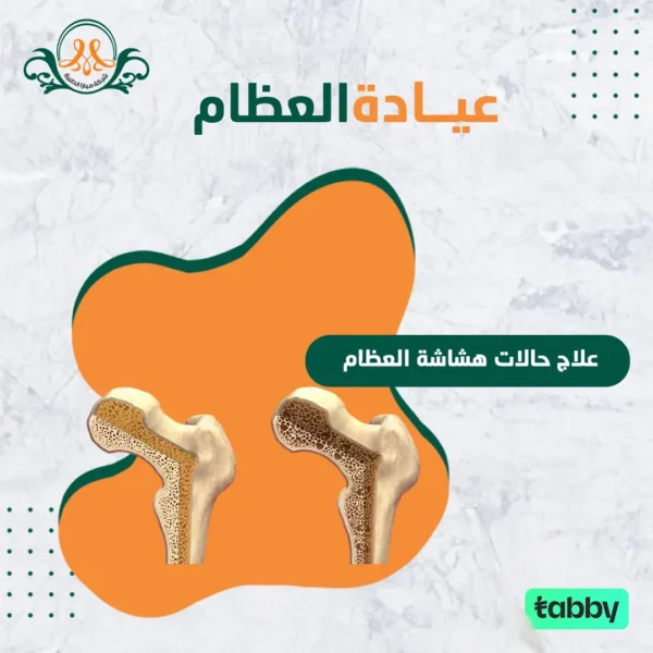 علاج حالات هشاشة العظام