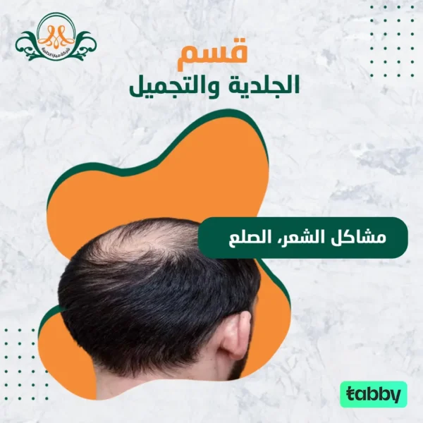 مشاكل الشعر، الصلع