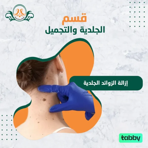 إزالة الزوائد الجلدية