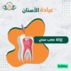 إزالة عصب سني