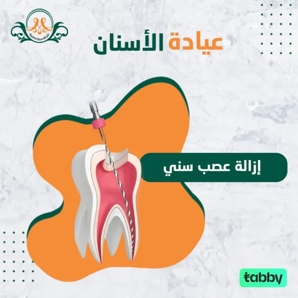 إزالة عصب سني
