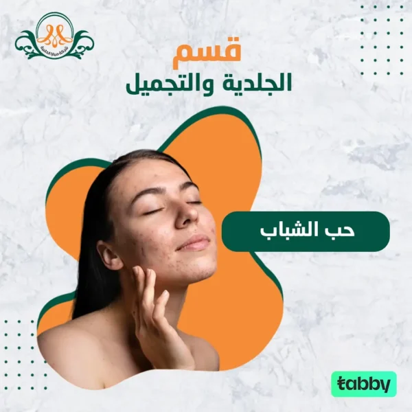 حب الشباب