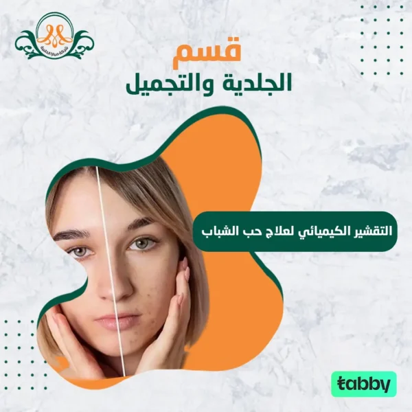 التقشير الكيميائي لعلاج حب الشباب