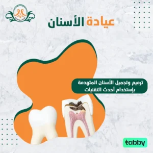 ترميم وتجميل الأسنان المتهدمة بإستخدام أحدث التقنيات