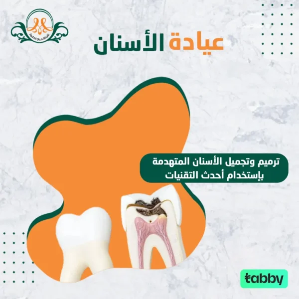 ترميم وتجميل الأسنان المتهدمة بإستخدام أحدث التقنيات