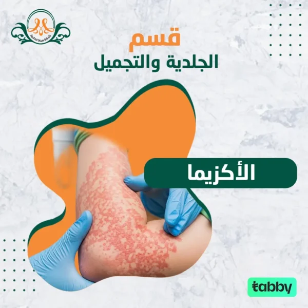 الأكزيما