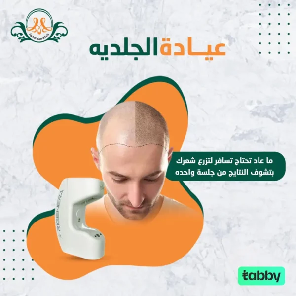 ريجينيرا لعلاج تساقط الشعر التفاعلي و الصلع الوراثي